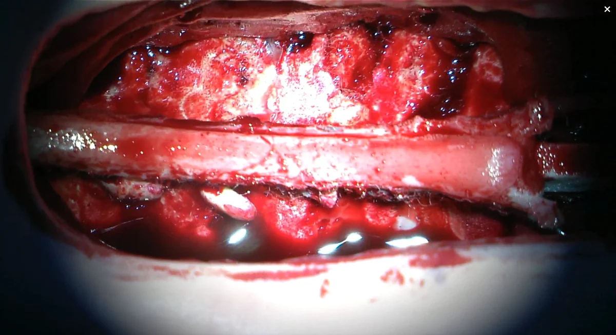 Cervical posterior open approach