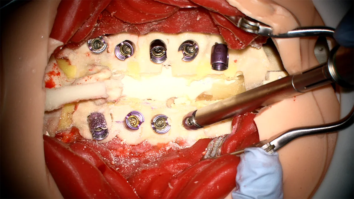 Cervical posterior screws